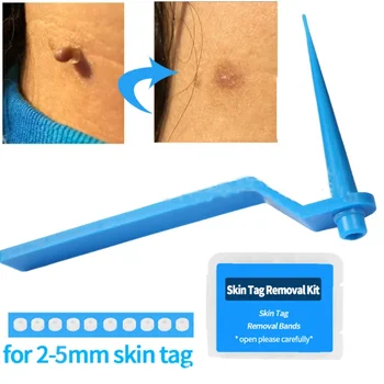 1set Skin Tag Kill Skin Mole Wart Removal Micro Skin Tag Removal Kit with Cleansing Tampon Adult Mole Wart Facial Treatment